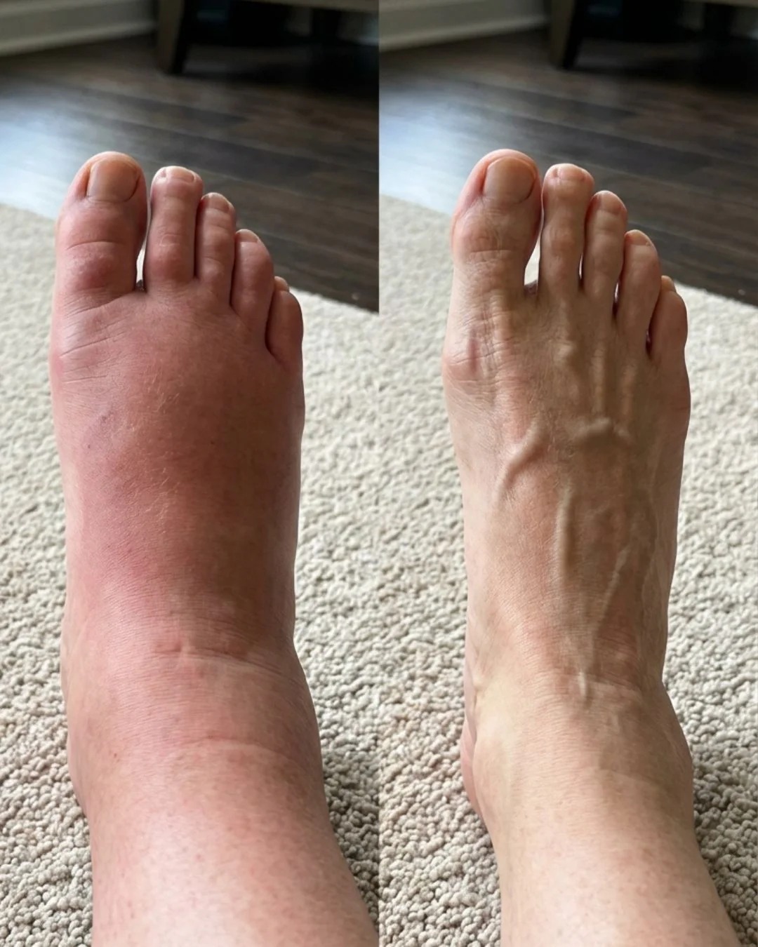 Antes e depois: pé com inchaço e pé desinchado